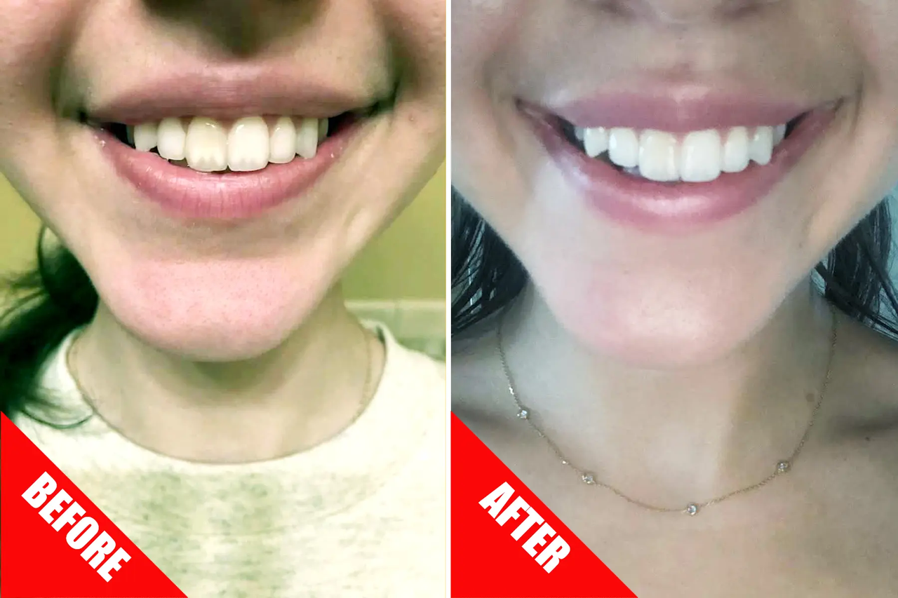 Colgate before and after
