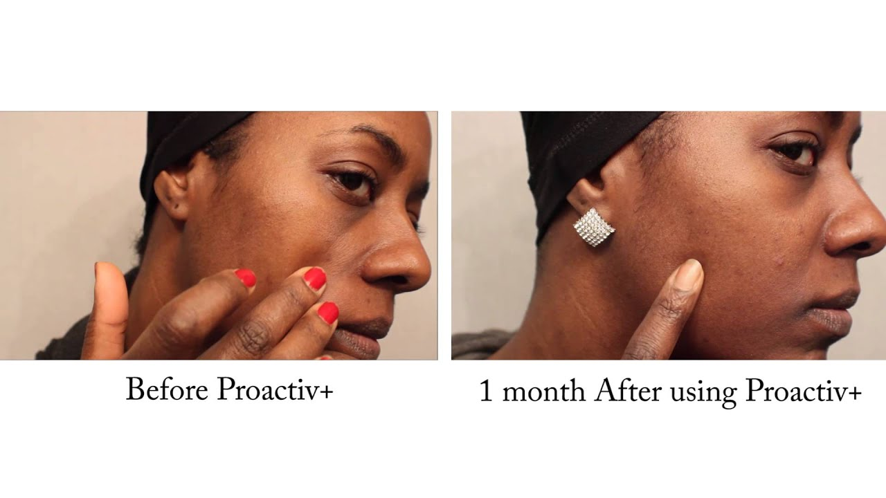 Proactiv before and after